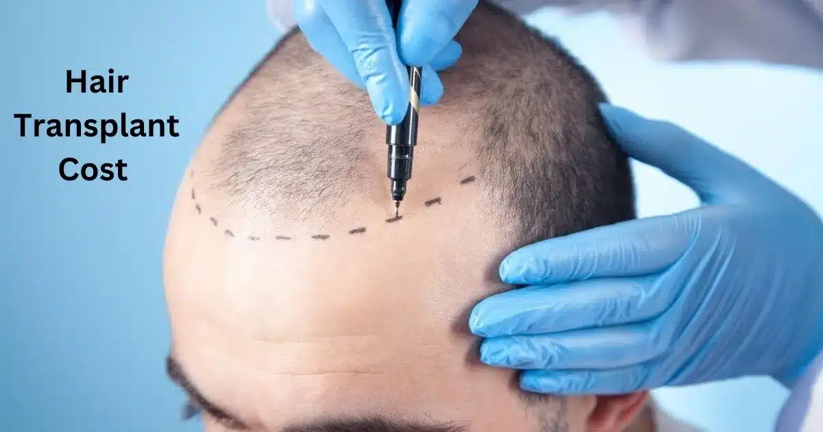 How Much Does a Hair Transplant Cost in Separate Countries?