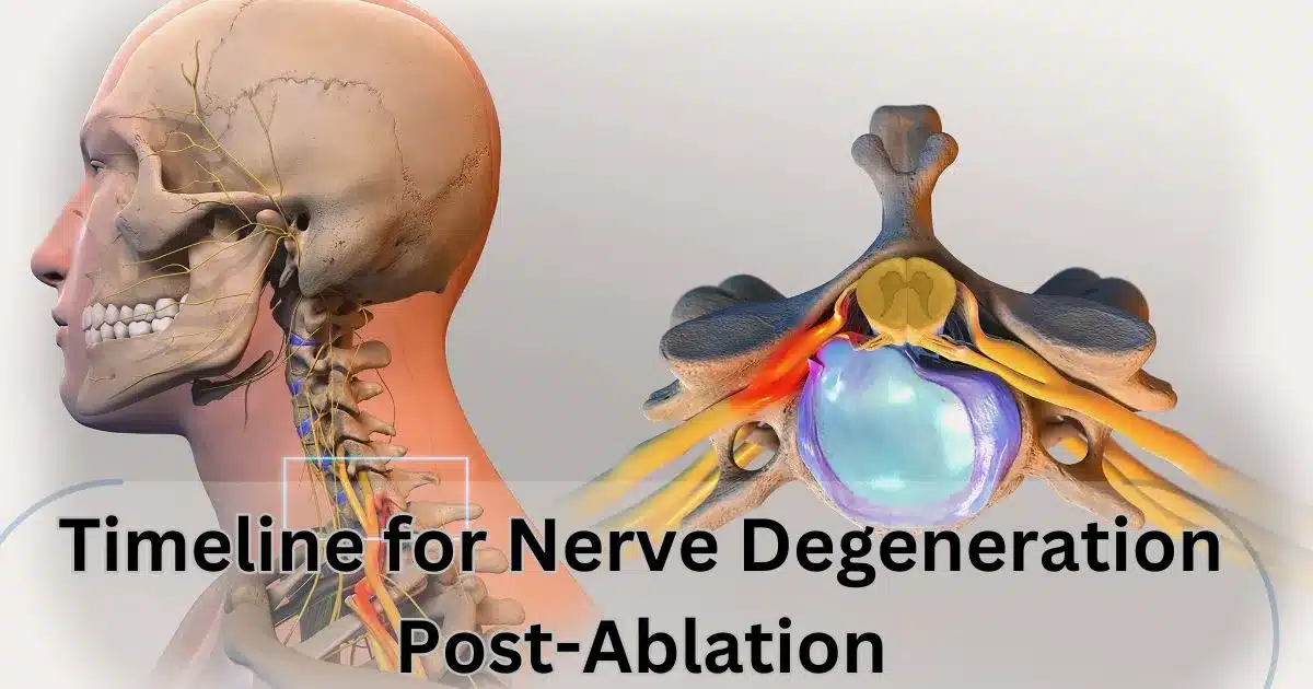 Timeline for Nerve Degeneration Post-Ablation